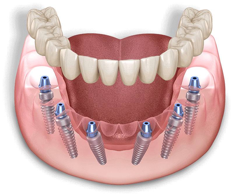 full arch dental implant model graphic