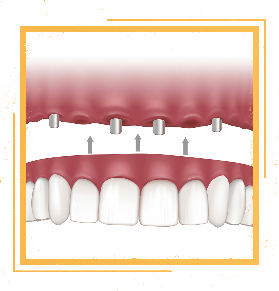 overdentures